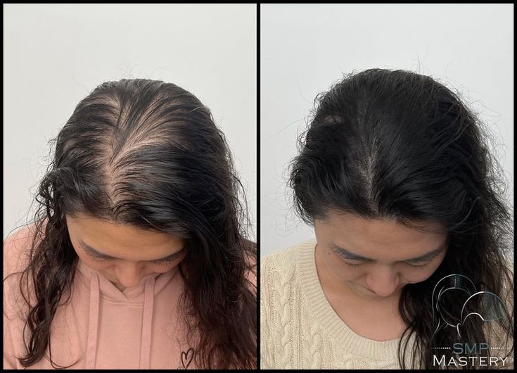 Scalp Micropigmentation